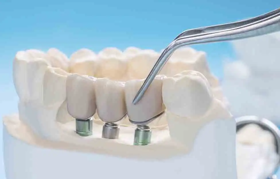 implante dental.jpg